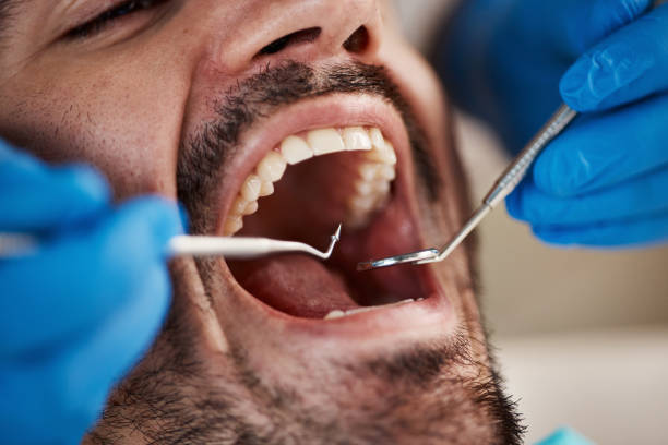 Best Emergency Tooth Extraction in Buford, GA