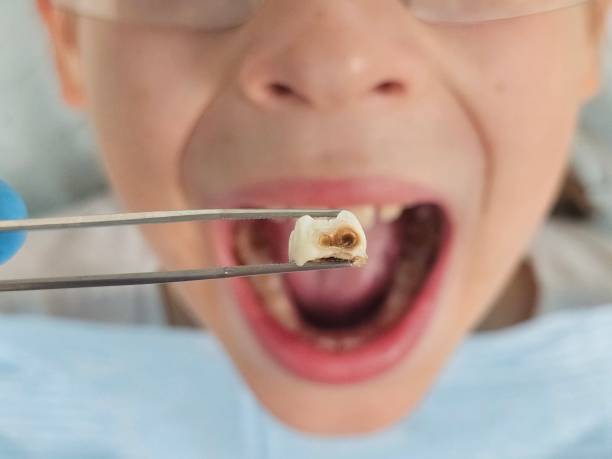 Best Emergency Treatment for Toothache in Buford, GA
